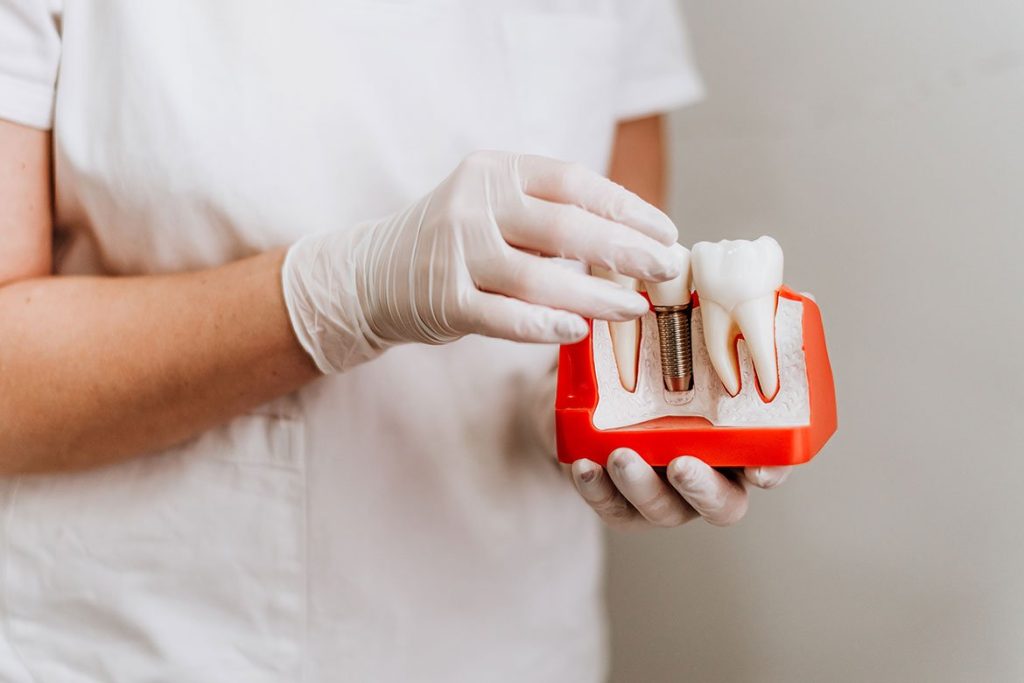 All on 4 Dental Implants Turkey