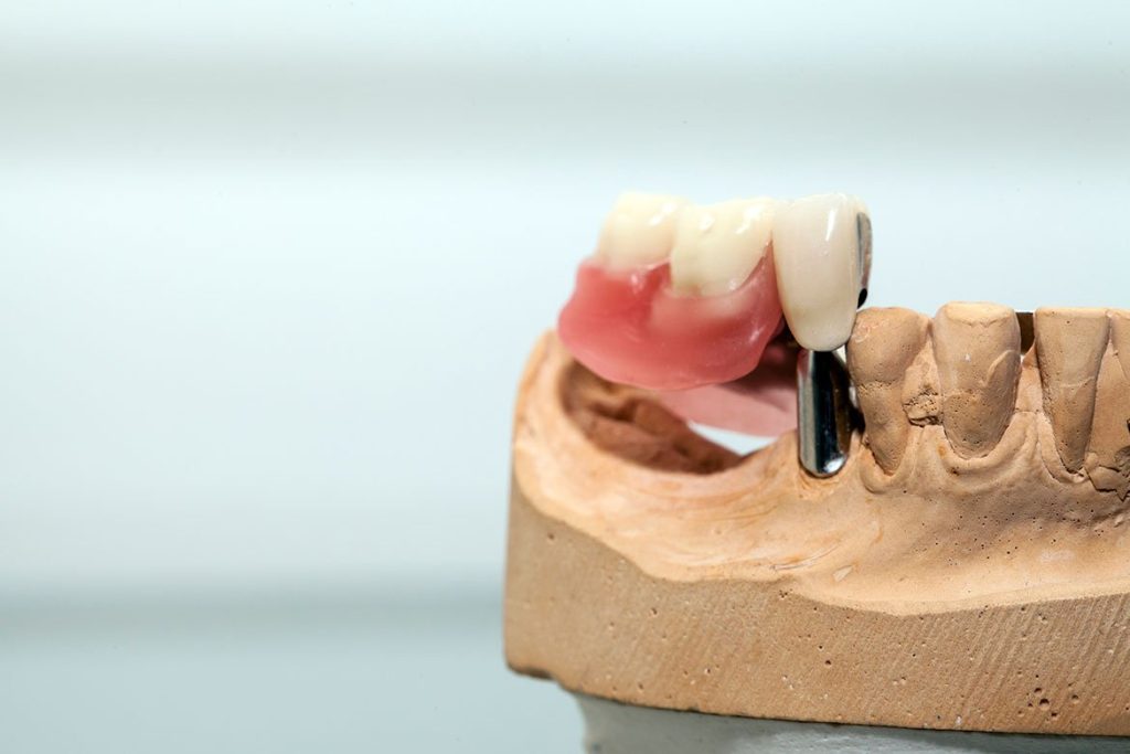 What Are Dental Implants