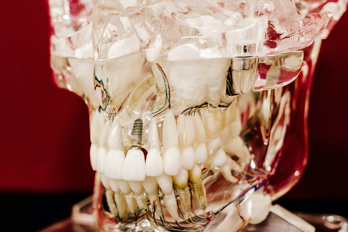 How Long Do Dental Implants Last? Dental Park