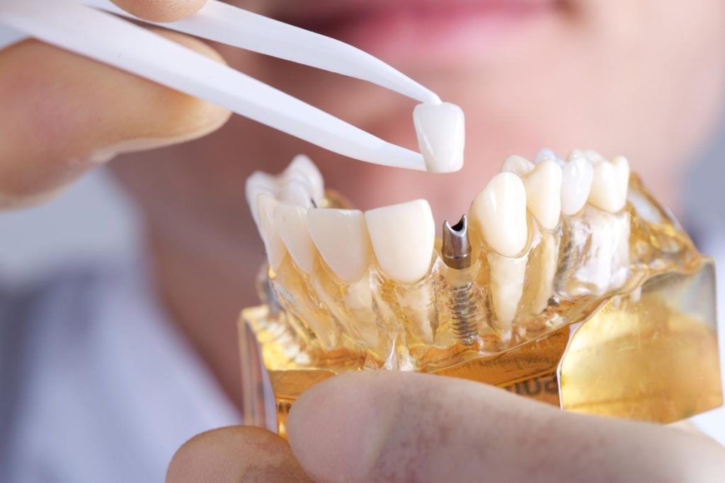 Dental Implant Procedure