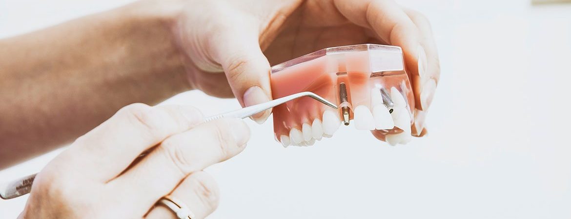 All on 4 Dental Implants Problems
