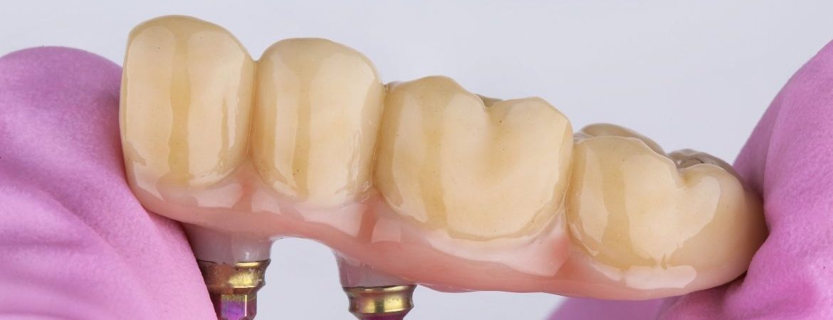Dental Bridge Vs Implant