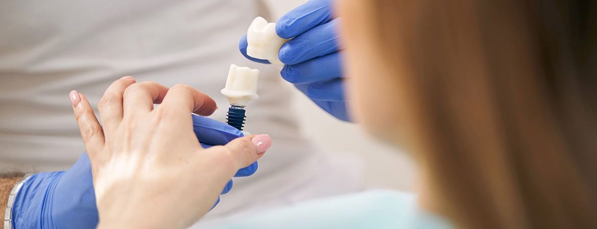 How Much Are Dental Implants?