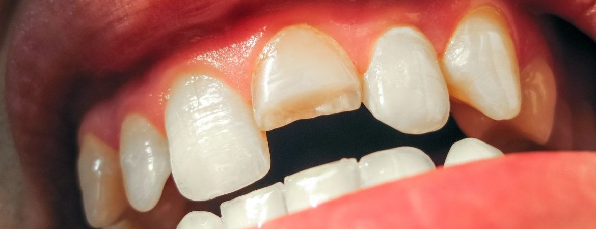 Kırık Diş Tedavisi
